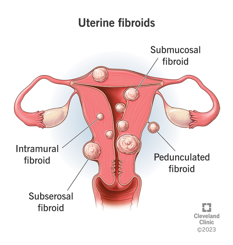 Fibromas Uterinos